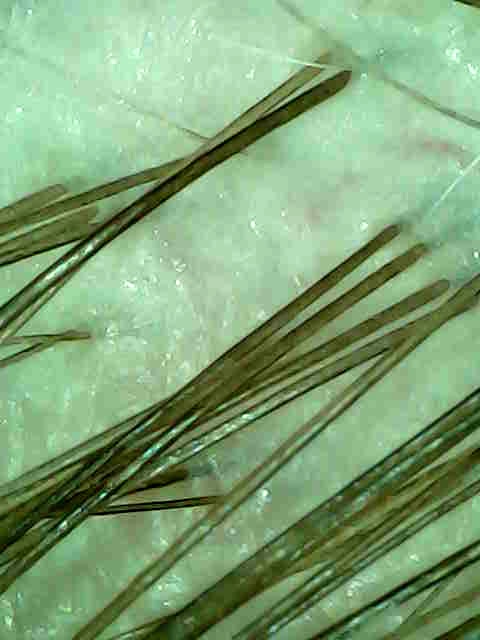 After the Scacial: a smooth, calm scalp with clear follicles.
