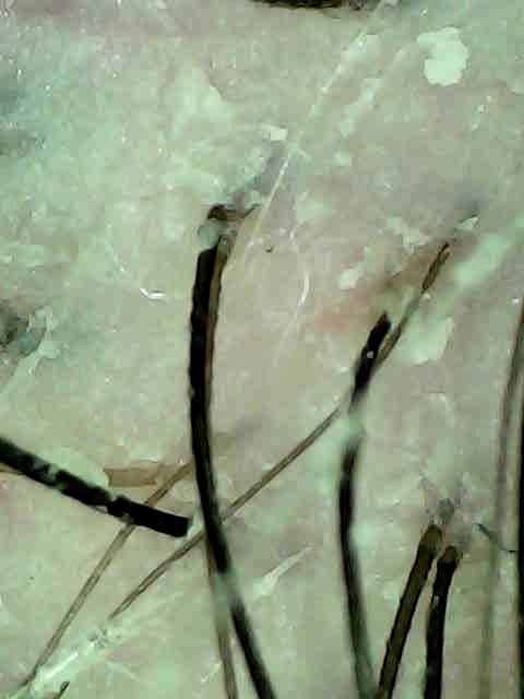 Before the Scacial: flaky buildup and debris around the follicles.