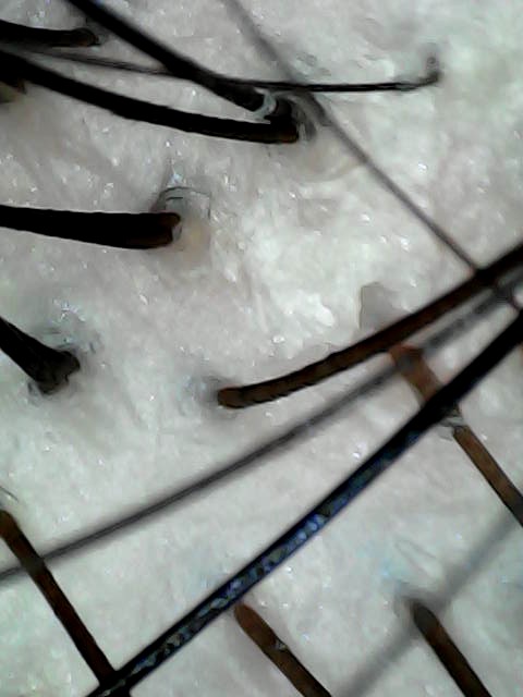 Before the Scacial: dry flakes around the follicles.